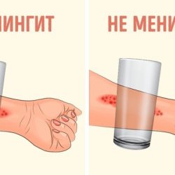 Что с менингитом в Гомеле